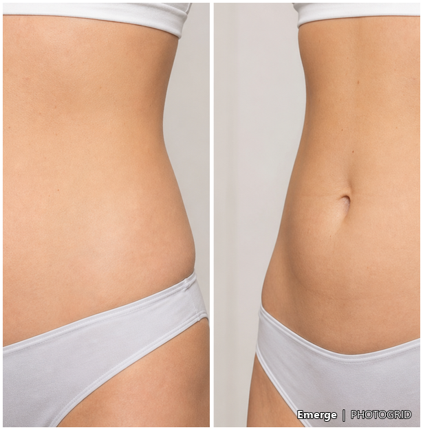 Illustrative body contouring result reference