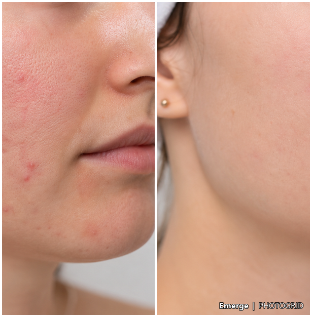 Illustrative LED acne support result reference