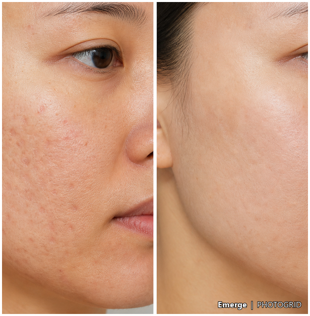 Illustrative RF microneedling texture result reference
