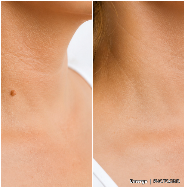 Illustrative skin tag removal result reference